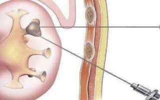 做肾穿刺有危险吗 肾穿刺前不能吃什么药