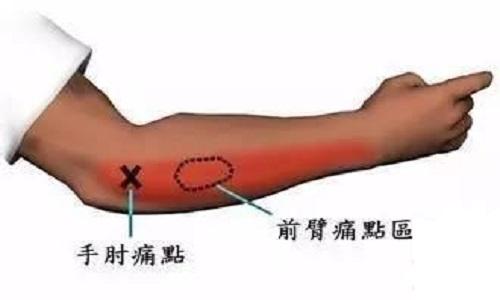 网球肘按摩手法图