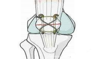 髌骨骨折手术后多久可以做弯曲动作 髌骨骨折术多久下地走路