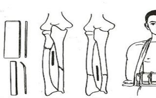 桡骨骨折的临床表现 桡骨骨折要手术治疗吗