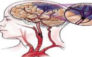 脑梗死是什么病 脑梗死会危及生命吗