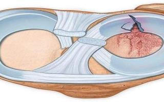 半月板损伤是严重的伤吗 半月板损伤拍片可以拍出来吗