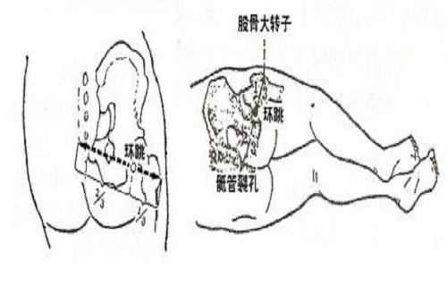 环跳