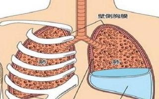 胸腔积液是怎么形成的 胸腔积液的症状有哪些