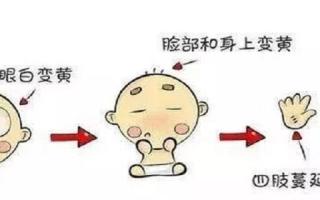 母乳黄疸怎么判断 母乳性黄疸的临床表现