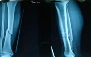 胫骨平台骨折一定要手术吗胫骨平台骨折休息多长时间 润疗养生网runliao Com 胫骨平台骨折一定要手术吗胫骨平台骨折休息多长时间 润疗养生网runliao Com