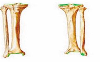 胫骨腓骨的区分 胫骨腓骨断了多长时间能好